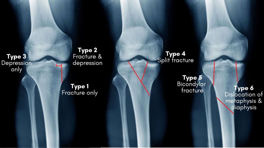 Tibial Plateau Fracture Causes Symptoms And Treatment