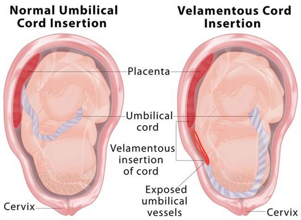 Velamentous Cord Insertion The Hidden Pregnancy Risk