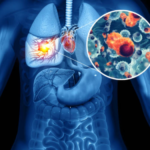 Lung Cancer Symptoms: If these symptoms are seen in lung cancer