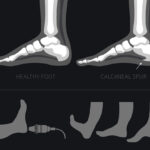 Effective Treatment for Heel Spur Pain Effective Treatment for Heel Spur Pain