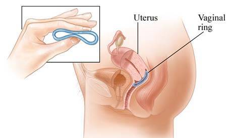 Nuvaring-Birth-Control-Vaginal-Ring
