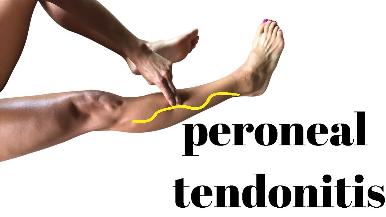 Peroneal Tendonitis Causes Symptoms And Treatment Options