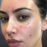 Dealing with Psoriasis on the Face: Tips and Treatment Options Psoriasis on the Face