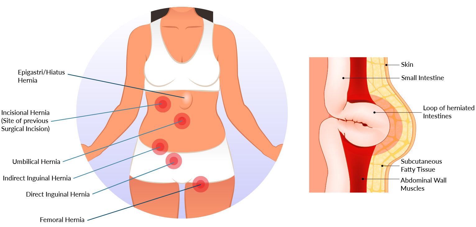 Types of Hernias