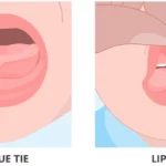 Understanding Lip Tie: Causes, Symptoms, and Treatment lip tie and tounge tie