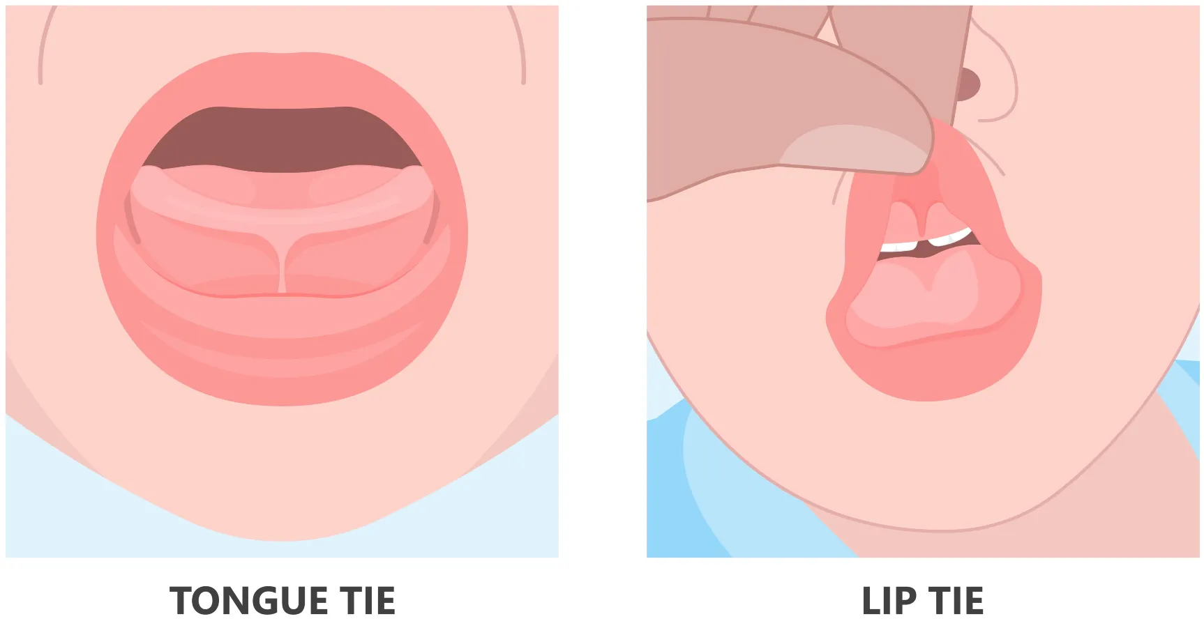 lip tie and tounge tie