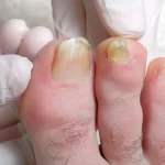 Yellow Toenails: Causes, Treatment, and Prevention yellow toenails