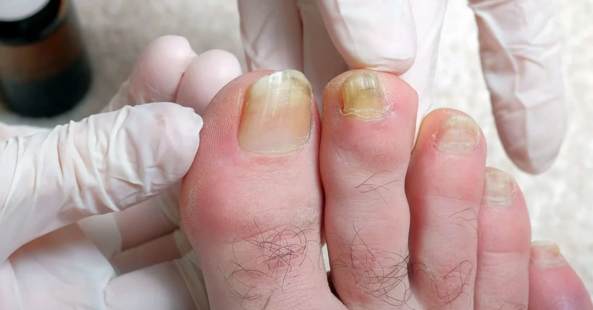 yellow toenails