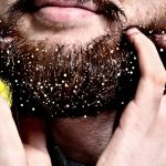 The Ultimate Guide to Banishing Beard Dandruff for Good beard dandruff