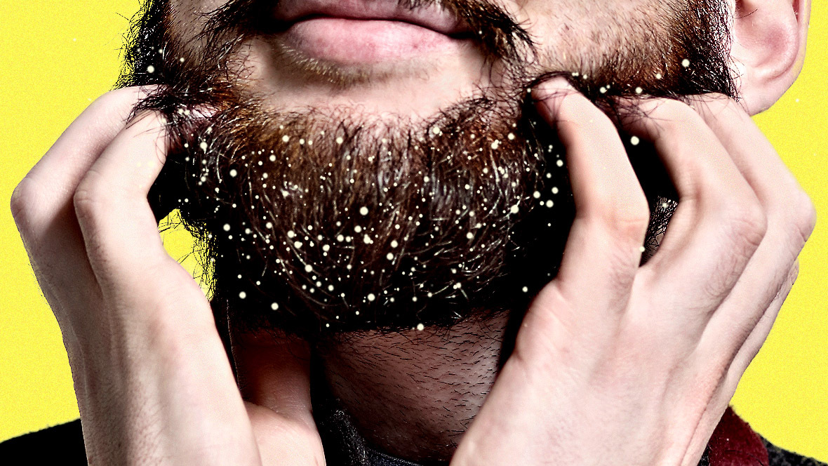 beard dandruff