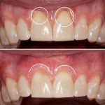 All You Need to Know About Gum Graft: Procedure, Recovery, and Cost Gum Graft