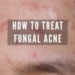 Fungal Acne: What it is and How to Treat it fungal acne