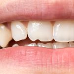 The Perils of a Chipped Tooth: Causes, Treatment, and Prevention