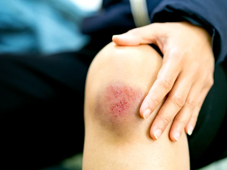 bone bruise