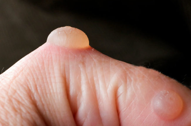 should you pop a blister