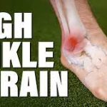 Understanding High Ankle Sprain: Causes, Symptoms, and Effective Treatment
