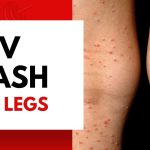 Decoding HIV Rash: Understanding Symptoms, Variations, and Implications hiv rash