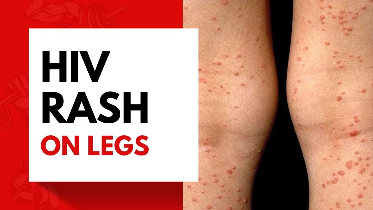 Hiv Rash Pictures Location Symptoms And Treatment 6207