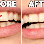 Chipped Tooth Repair: Restoring Your Smile and Dental Health