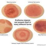 Erythema Migrans: The Telltale Sign of Lyme Disease Erythema Migrans