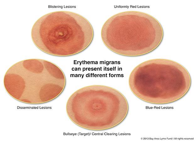 Erythema Migrans