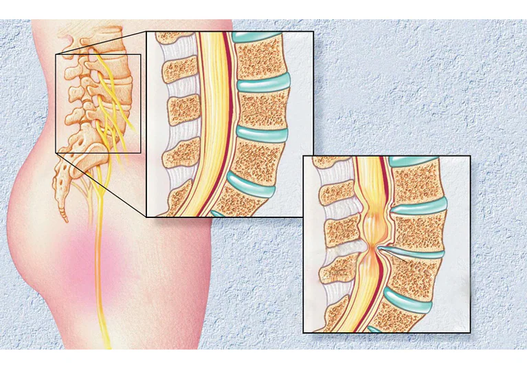 spinal stenosis surgery
