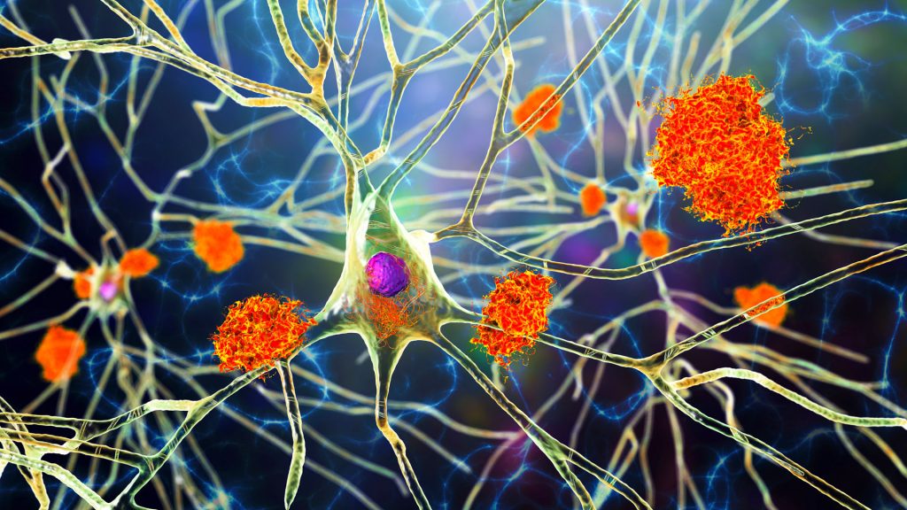 A brain scan revealing late-onset Alzheimer's disease
