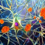 Study Says: Eli Lilly’s experimental Alzheimer’s drug slows progression of the disease A brain scan revealing late-onset Alzheimer's disease