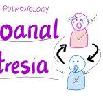 Understanding Choanal Atresia: A Rare Nasal Condition Explained Choanal Atresia