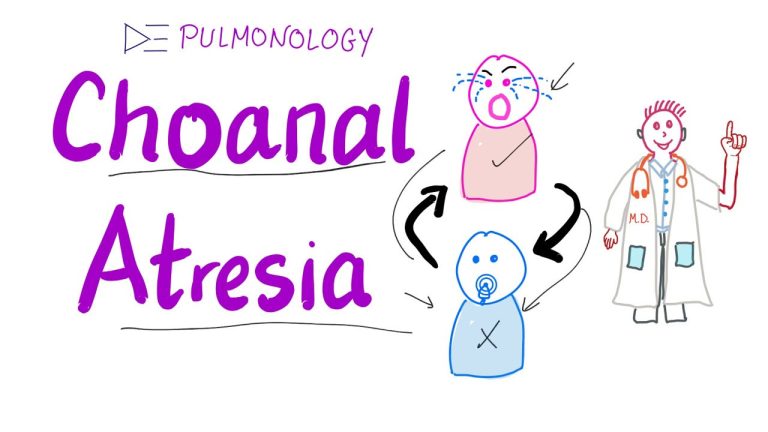 Understanding Choanal Atresia: A Rare Nasal Condition Explained