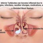 Deviated Septum Surgery: Breathing Easier and Living Better Deviated Septum Surgery