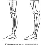 Understanding Hyperextended Knee: Causes, Symptoms, and Treatment Hyperextended Knee