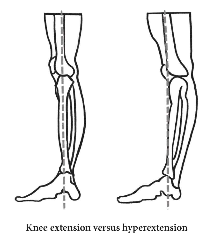 Understanding Hyperextended Knee Causes Symptoms And Treatment