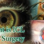 ICL Surgery: A Comprehensive Guide to Implantable Contact Lens ICL surgery