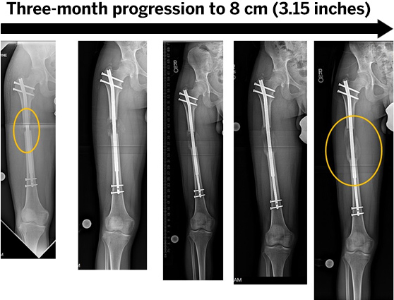 Leg Lengthening Surgery