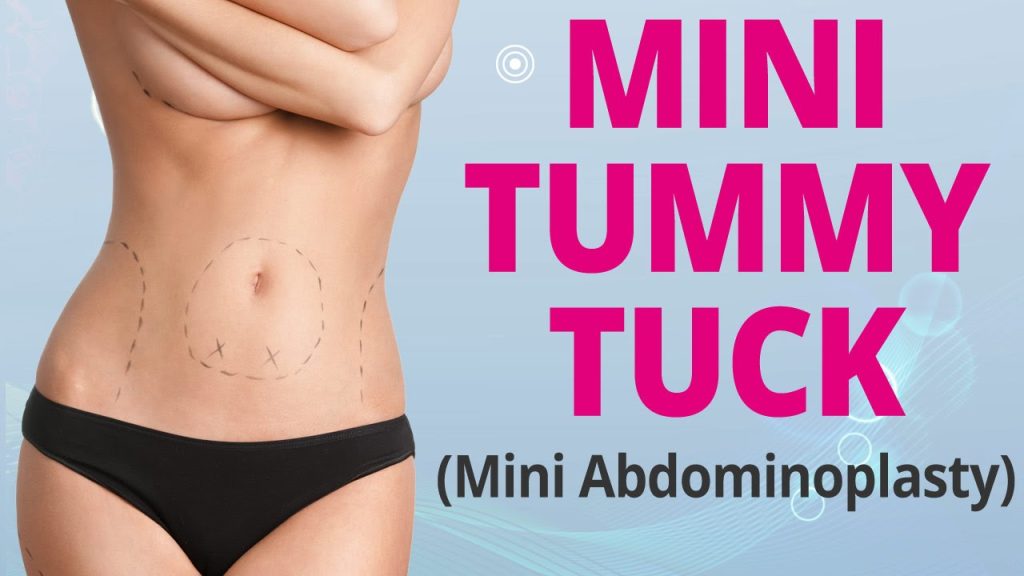 Mini Tummy Tuck