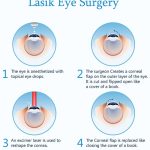 PRK vs. LASIK: Which Vision Correction Procedure Is Right for You? PRK vs. LASIK