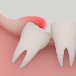 Understanding Pericoronitis: Causes, Symptoms, and Treatment Pericoronitis