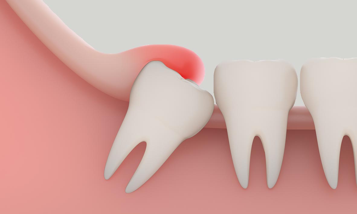 Understanding Pericoronitis: Causes, Symptoms, And Treatment