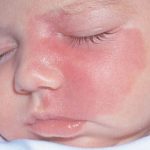 Port Wine Stain: Understanding Causes, Treatment Port Wine Stain