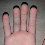 Dealing with a Sprained Finger: Causes, Symptoms, and Recovery Sprained Finger