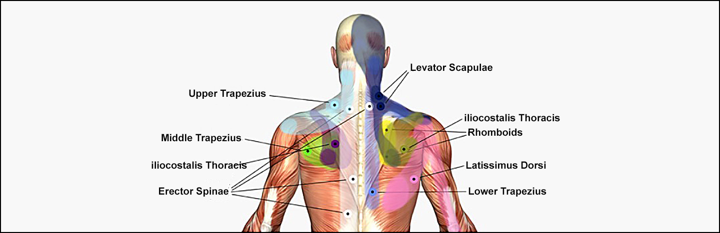 Trigger Point Injections