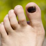 Black Toe Nail: Causes, Treatment, and Prevention black to enail