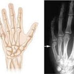 Mending the Hurt: Coping with a Broken Finger broken finger