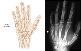 broken finger