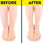 Cankles: Causes, Treatment, and Tips for Slimmer Ankles