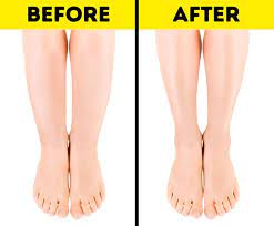 Cankles: Causes, Treatment, and Tips for Slimmer Ankles