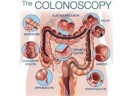 colonoscopy near me