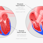 Understanding Diastolic Heart Failure: Causes, Symptoms, and Management diastolic heart failure