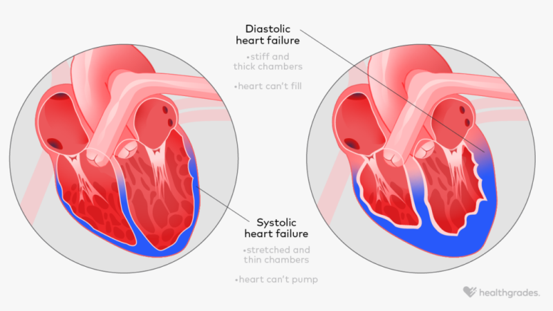 diastolic heart failure
